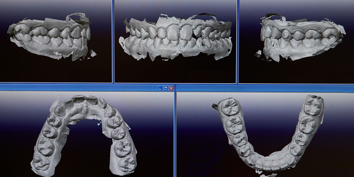 digital scans of teeth